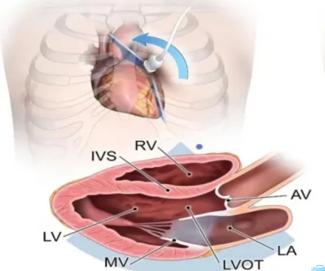 心脏超声知多少